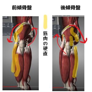骨盤の歪みによる筋肉の硬直によるバランスを失い、腰痛の原因