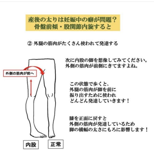 太もも周囲の大腿筋と歩き方のクセのイメージ図