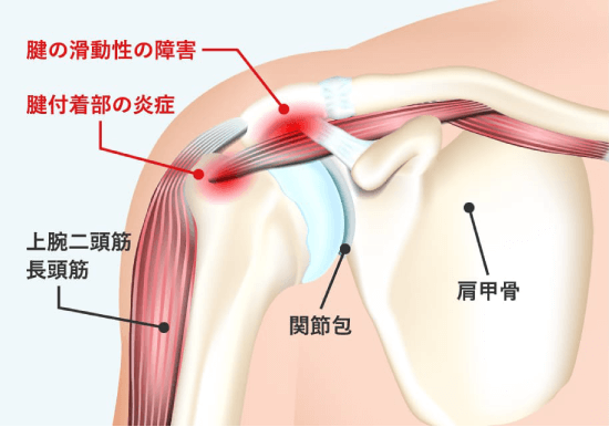 Frozen-shoulder - inflamed-area