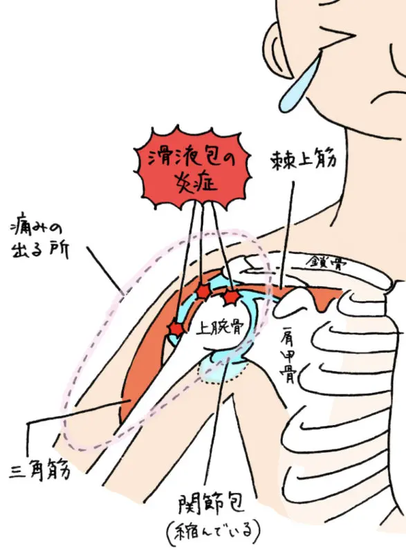 Frozen-shoulder,-pain