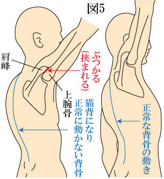 Hunchback-causes- frozen -houlders