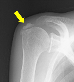 Causes of-calcific-tendonitis-frozen-shoulder