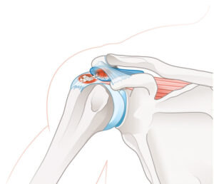 Shoulder Calcium, Deposition-Tendonitis, - Causes-of-Frozen-Shoulder