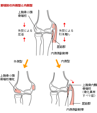 Baseball-elbow - lateral and-medial types