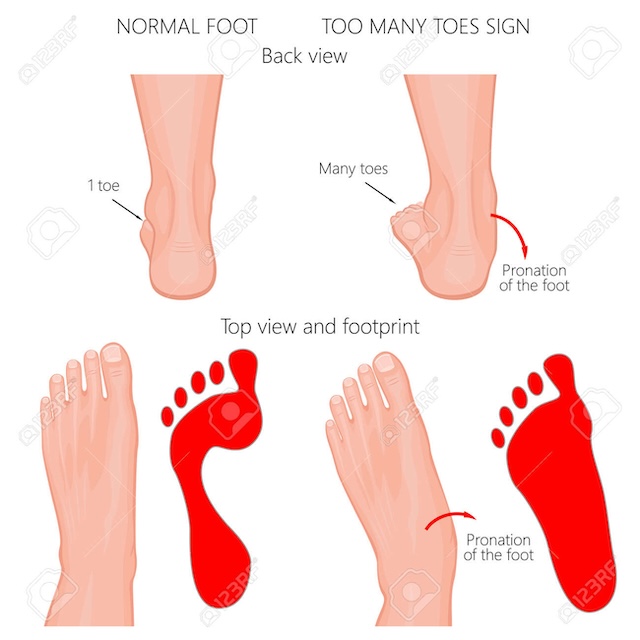 Vector illustration of a normal human foot and a foot with pronation or flatfoot, a deformity of the hindfoot
