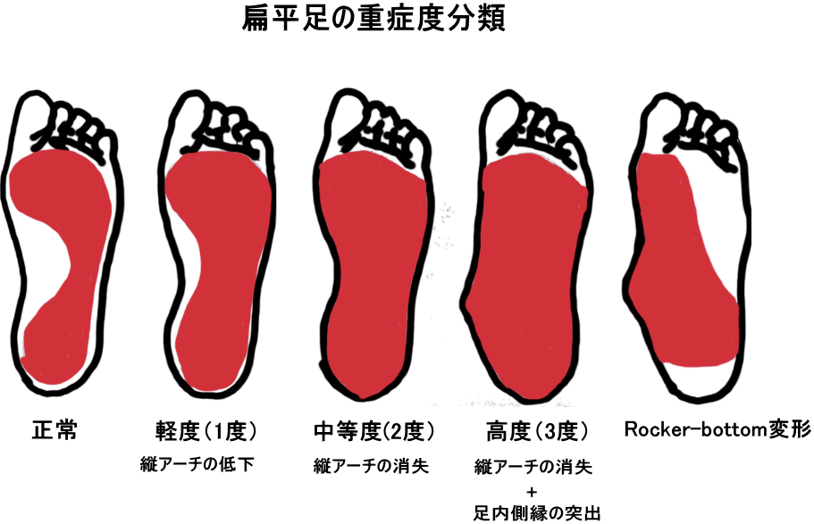 Flatfoot-severity-classification