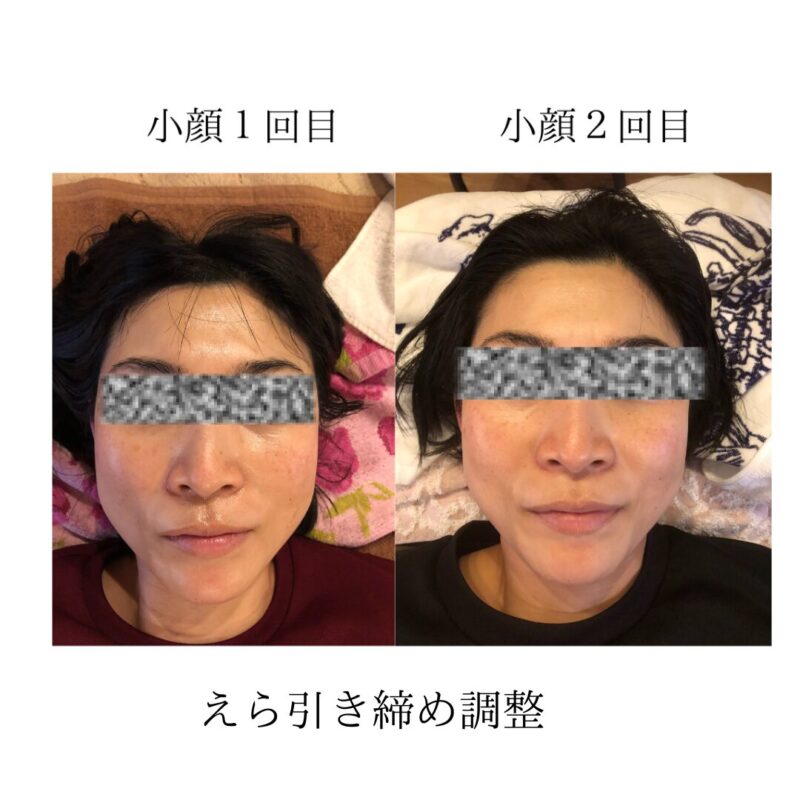 Small-face-before-and-after