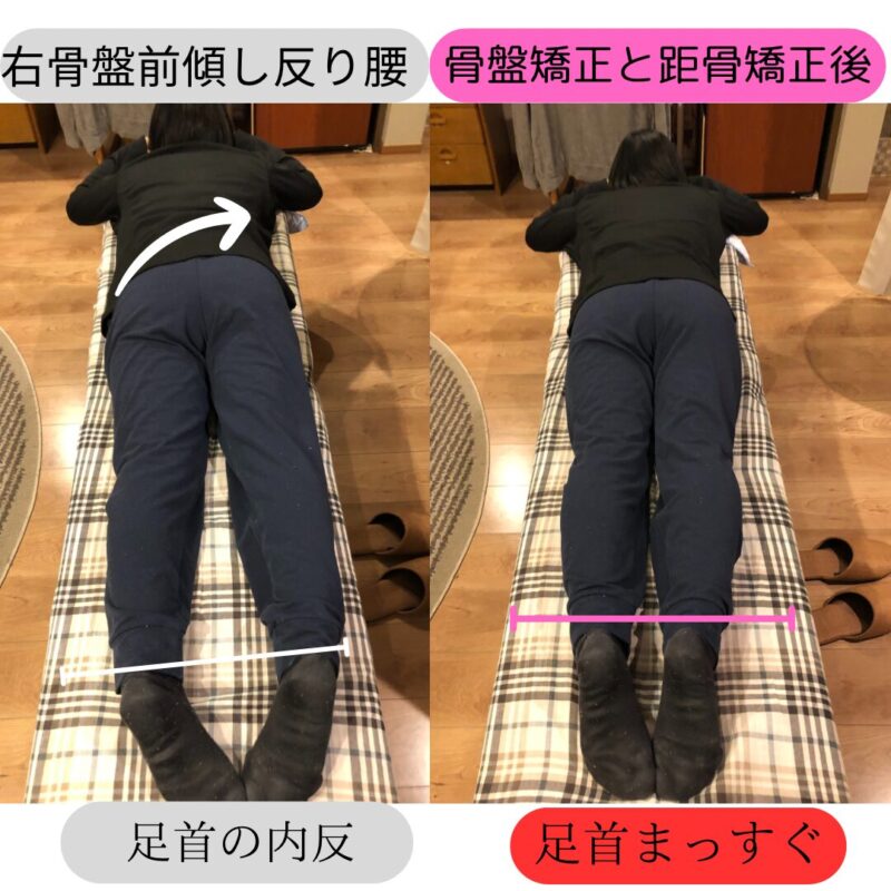 Ankle-and-pelvic-alignment