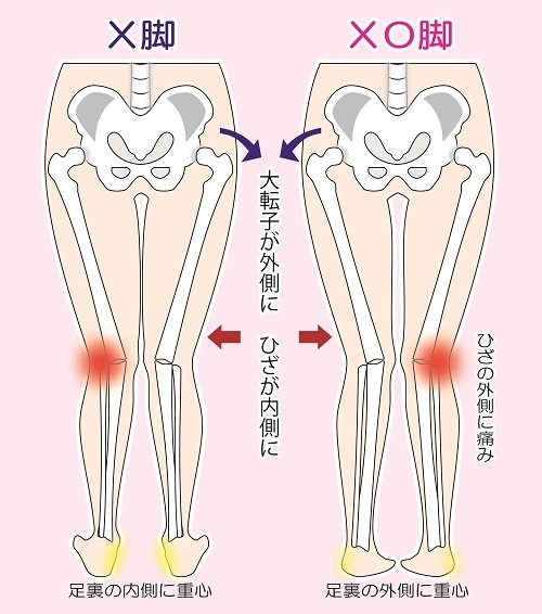 X脚O脚の悩み