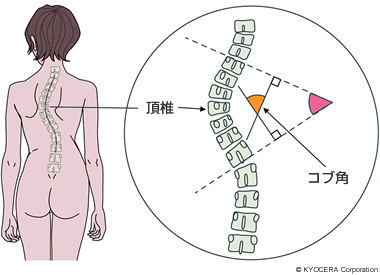 scoliosis-cobb-degree