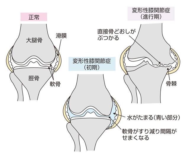 knee-osteoarthritis