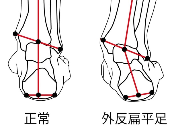 外反扁平足と正常な足首のイメージ図
