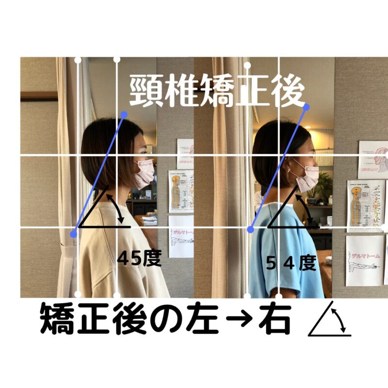 ストレートネック改善後の頭蓋形態角