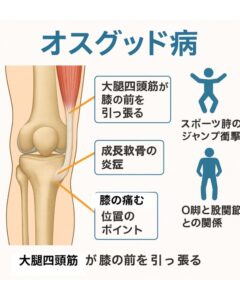 オスグッド痛みと解剖学イメージ図