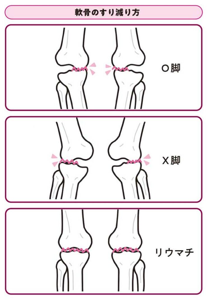 軟骨のすり減り方.