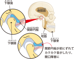 temporomandibular-joint-disorder