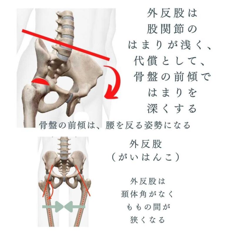 Hip-valgum-internal- rotation -medial-hip -oint