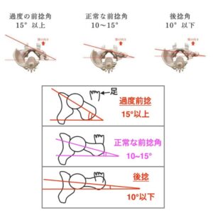 前捻角の正常角度サンプル