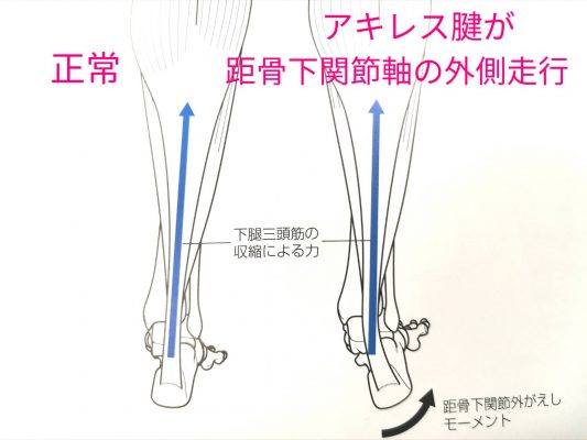 Tension of the posterior-
-tibia-due to- eversion-of-the-talus