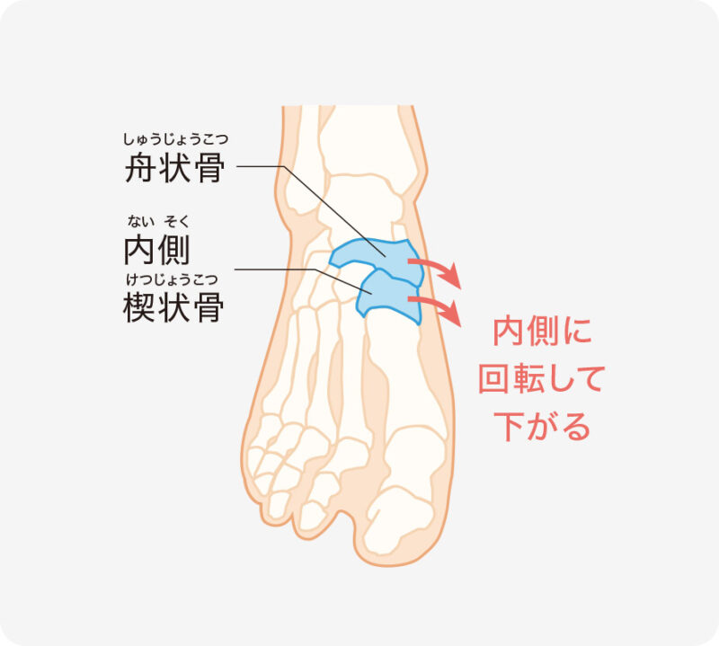 Rotational- adduction- relative-to-the- navicular-bone.