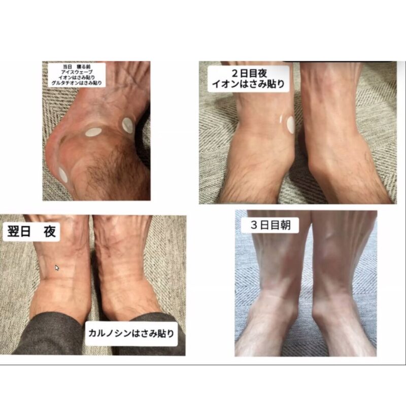 足のむくみの経過