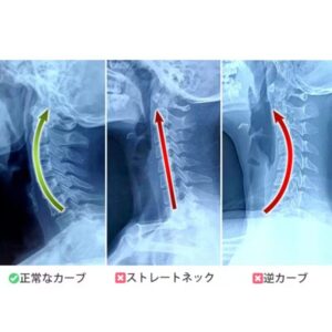 頸椎の歪み、ストレートネックと正常なカーブ