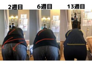 姿勢改善のする前とした後の経過の写真13週間