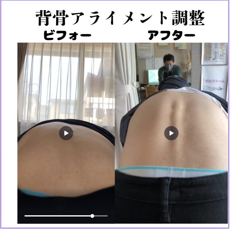 背骨アライメント