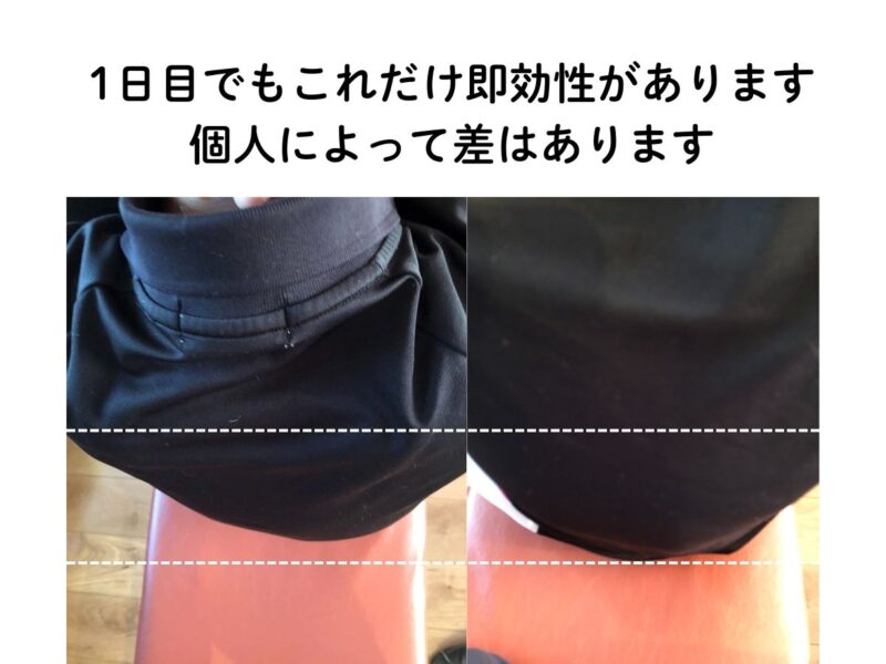 背骨の矯正後50分後